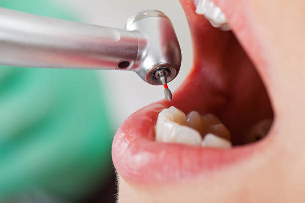 Best Emergency Root Canal Treatment in University Of Virginia, VA